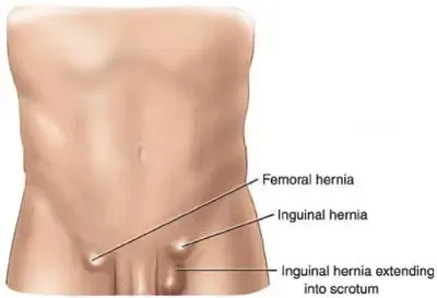 ilustrasi hernia ingunalis